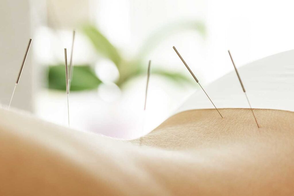 Acupuncture